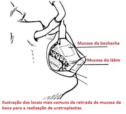 Uretroplastia substitutiva com o tecido da mucosa de boca como tratamento de estenose de uretra