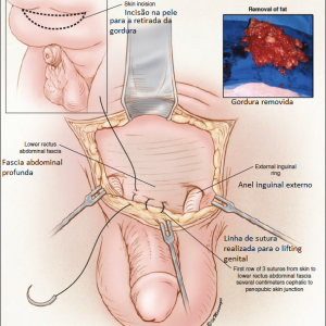 Cirurgia de pênis embutido - urologia reconstrutora 